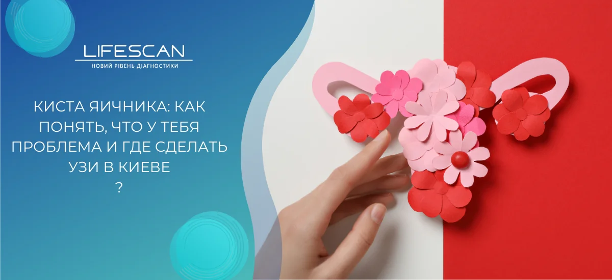 Киста яичника