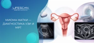миома матки