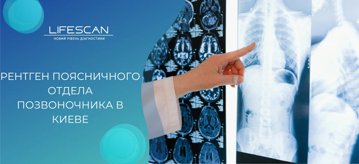 нтген поясничного отдела позвоночника