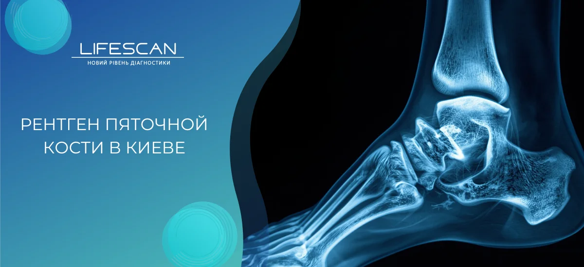 рентген пяточной кости