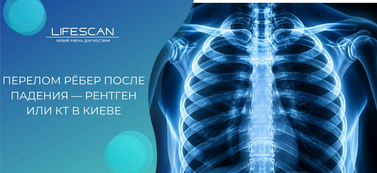 Перелом рёбер после падения