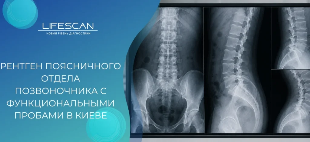 Рентген поясничного отдела позвоночника с функциональными пробами