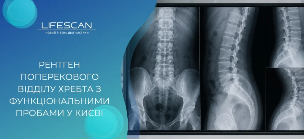 Рентген поперекового відділу хребта з функціональними пробами